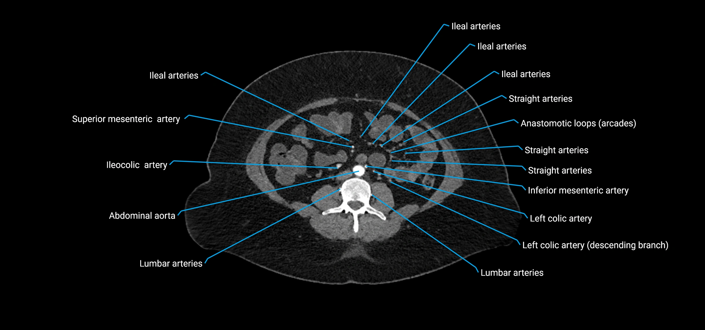 CTA abdomen axial cross sectional anatomy labelled image_118 (2).webp